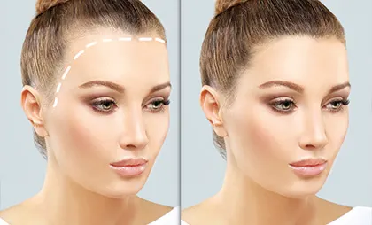 زراعة الشعر